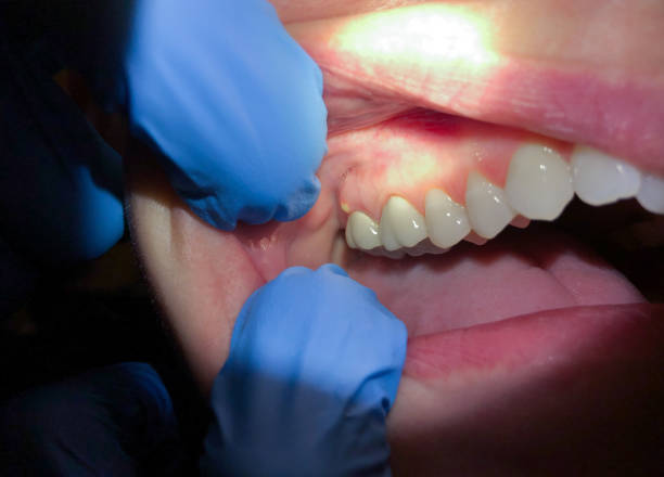 Best Emergency Care for Gum Disease in Cold Spring Harbor, NY